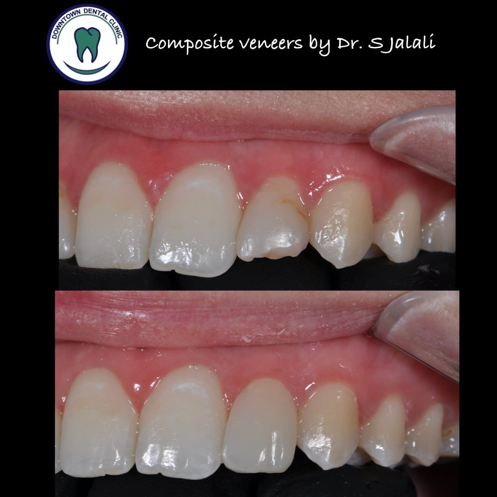 Composite veneers.002