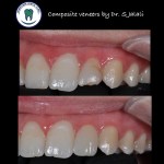Composite veneers.002