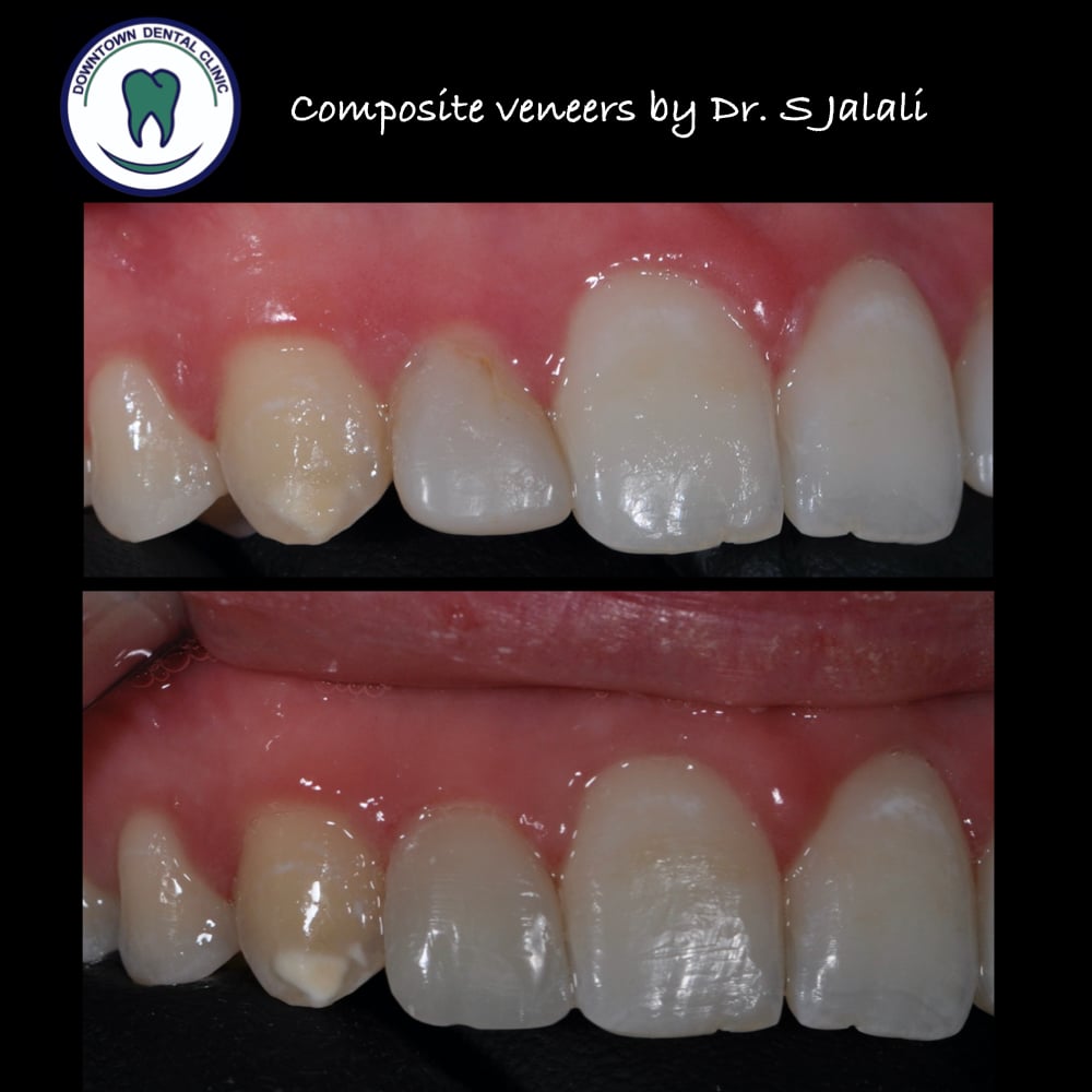 Composite veneers.003