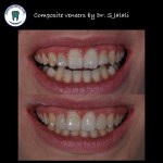 Composite veneers.004