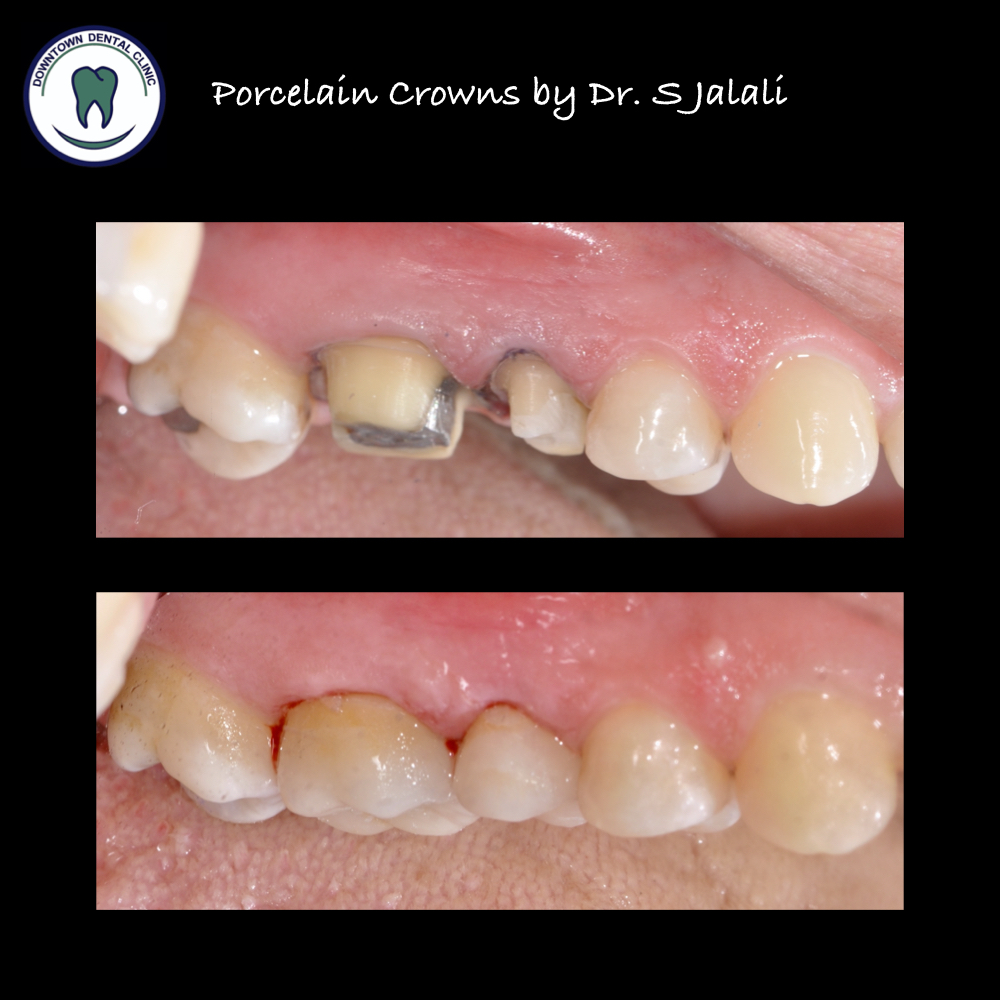 Porcelain Crowns .001