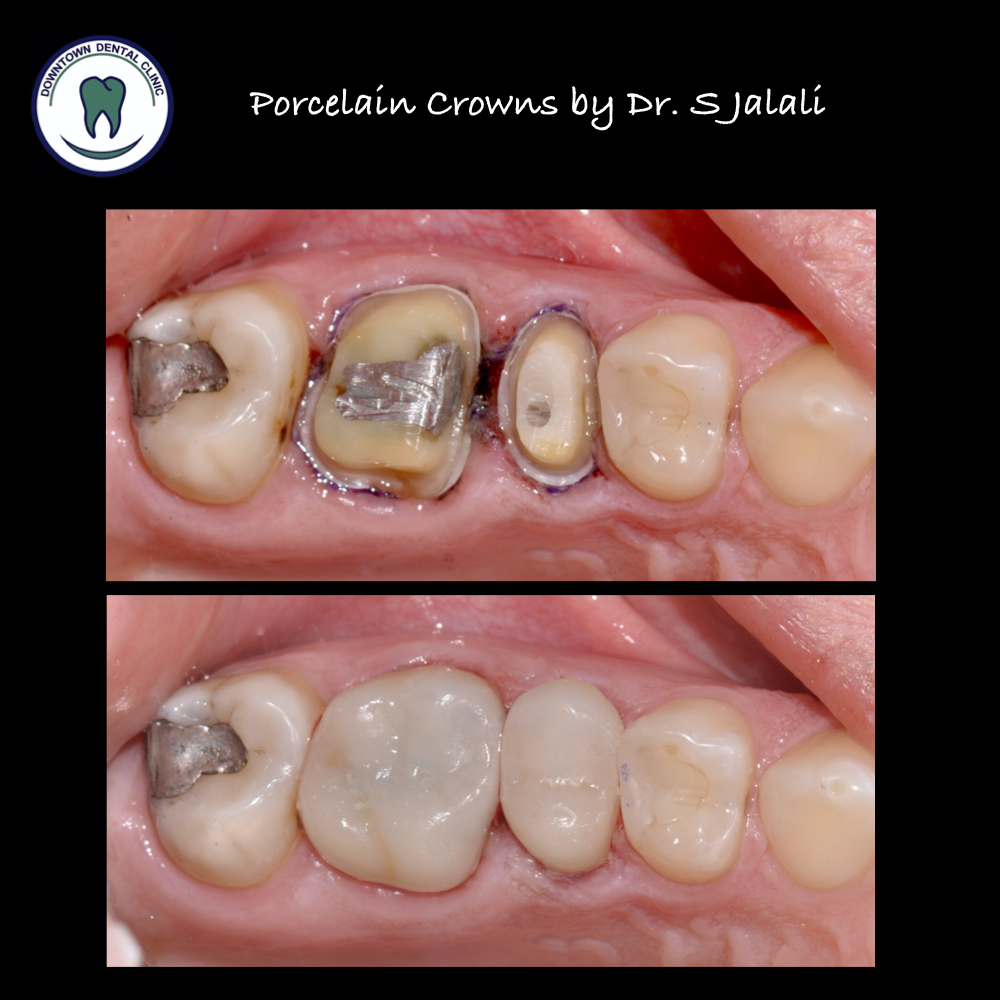 Porcelain Crowns .002