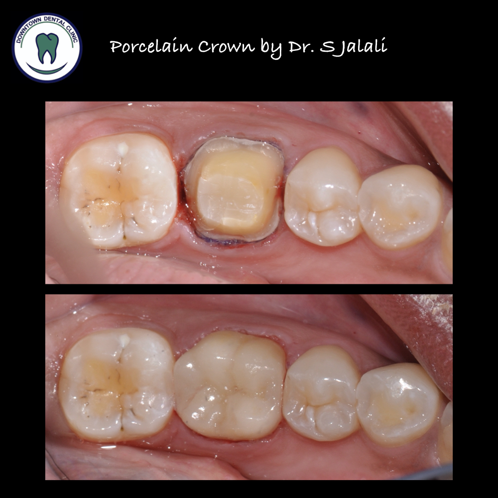 Porcelain Crowns .003