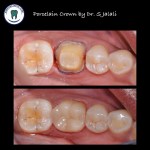 Porcelain Crowns .003