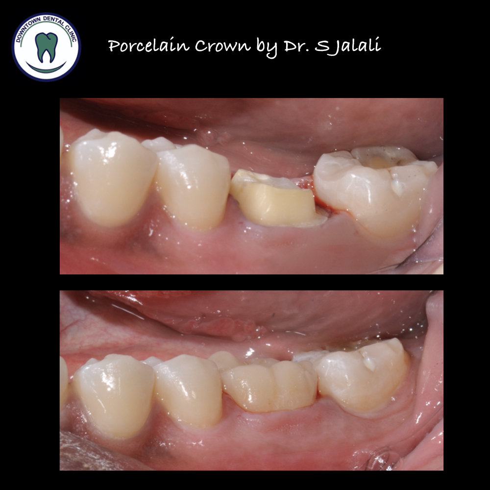 Porcelain Crowns .004