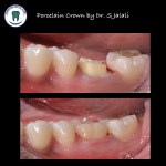Porcelain Crowns .004